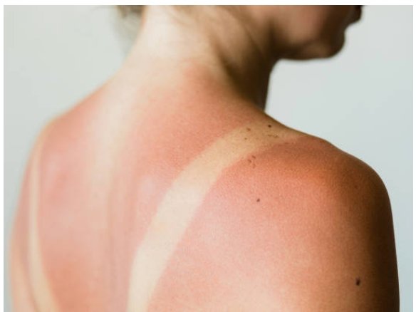 Can I Use CBD For Sunburns? - Erth Wellness